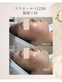 フォルディオ(FORDIO)/ララピール×LDM