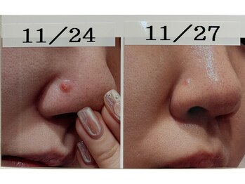 パルティール 恵比寿店(partir)/ポツンとニキビ４日でさよなら♪