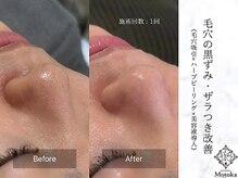 リラックスアンドビューティー モトカ(Motoka)/《毛穴の黒ずみ／開き》