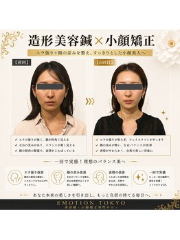 エモシオン トウキョウ(EMOTION TOKYO)/造形美容鍼×小顔矯正