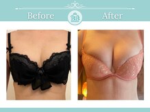 美人バスト 表参道店/【バストアップ/育乳 症例】