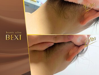 ベクスト(BEXT)/うなじ脱毛(PRO)