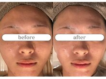 リスタ(RSTA)/【BEFORE/AFTER】