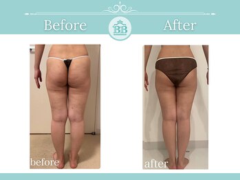 美人バスト 犬山店/【下半身ダイエット】症例♪