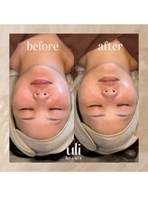 ウリ(uli beauty)/比較写真