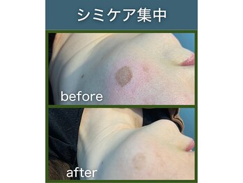 シアラ(SHIARA)/シミケア後の変化