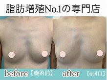 サラエクセレント 銀座/内側に脂肪が付いてきています♪