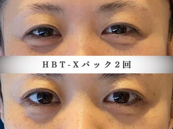 モルティー 宇都宮東店(Molti)/小顔矯正/目元ぱっちり/HBT-X