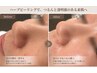 【OPEN記念】毛穴革命ケア！人気NO3REVIハーブピーリング