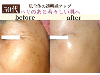パールホワイトニング/大きいシミ/老半改善で劇的変化