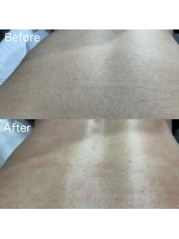 ア レーズ(a laise)/背中のワックス脱毛☆