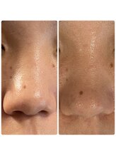 ハーシークレット(Her secret)/ハイドラ毛穴洗浄