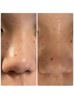 ハーシークレット(Her secret)/ハイドラ毛穴洗浄