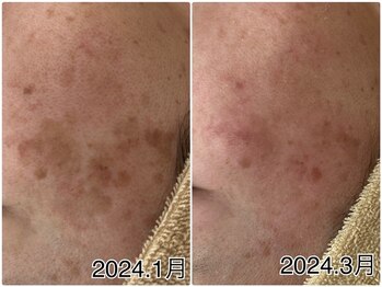 アップル 宇都宮店(Apple.)/肌改善プログラム