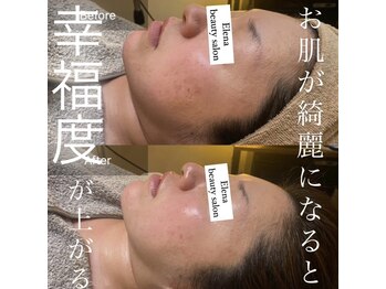 エレナ(Elena)/陶肌トリートメント