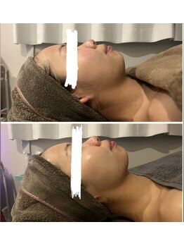 モア(moa)/小顔フェイスラインすっきり