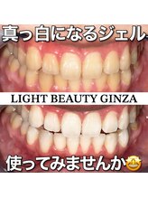 ライトビューティー 銀座店(LightBeauty)/東銀座 ホワイトニング症例写真