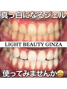 ライトビューティー 銀座店(LightBeauty)/東銀座 ホワイトニング症例写真