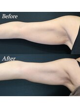 ブリエル(BRILLER)/脂肪冷却（二の腕）