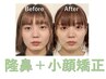 《満足度No.1》鼻矯正＋小顔矯正 40分13200→11000【美鼻/小顔】