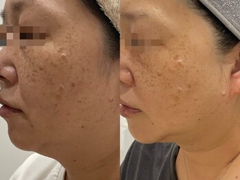 エミュ(emu)/レモンボトルとエクソソーム導入