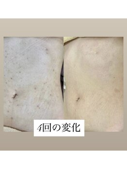 スキンプローズ(skinprose)/お腹ハーブピーリング・ハード