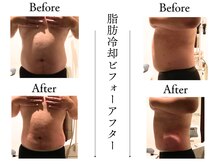 クローネ(Krone)/脂肪冷却ビフォーアフター