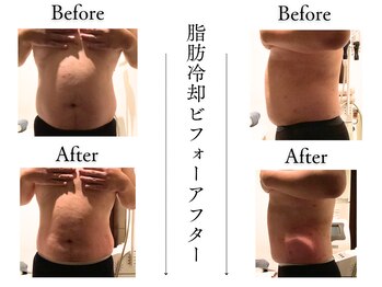 クローネ(Krone)/脂肪冷却ビフォーアフター