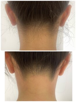 ウェイビーズ エステ(wavy's.esthetic)/【ビフォーアフター】うなじ脱毛