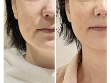 サロン キワ(salon kiwa)の雰囲気(口元のたるみ、ほうれい線を自然にリフトアップします。)