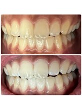 ラブホワイトニング 渋谷店(LOVEホワイトニング)/初回２回照射ホワイトニング