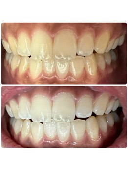 ラブホワイトニング 渋谷店(LOVEホワイトニング)/初回2回照射ホワイトニング