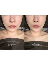 ハーゼ(Hase)/LDM/水玉トリプルリフティング