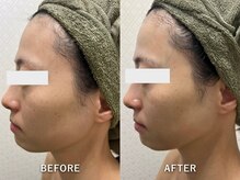 サロンドジェシカ(salon de Jessica)/毛穴洗浄+フォト美顔
