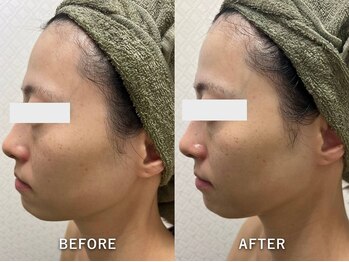 サロンドジェシカ(salon de Jessica)/毛穴洗浄+フォト美顔