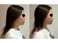 トゥジュール(Toujours)/骨格矯正美顔コース(さつま式)