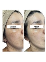 ル ボヌール 伊那店(le bonheur)/シミケア7ヶ月（月1回来店）