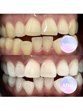ホワイトニングショップ 熊谷店/【before・after】