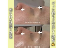 ハニエル(Haniel)/カーボキシー症例