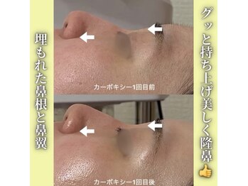 ハニエル(Haniel)/カーボキシー症例