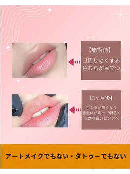 ラネージュ(LaNeige)の写真/話題の最先端技術DOLLPINK体験！気になる箇所の黒ずみを整え自信ある素肌へ◎
