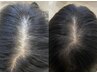【5回】厚生労働省が認めている薄い毛弱った毛にアプローチ美容技術！30万円