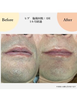 スリール(sourire)/ヒゲ脱毛