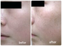 エミー(emy)/江坂/毛穴/ハーブピーリング