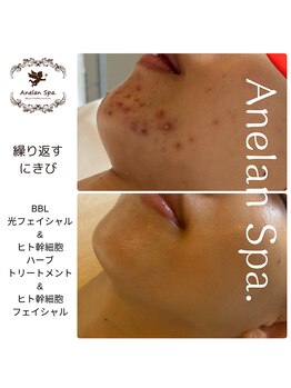 アネランスパ(Anelan Spa.)/肌質改善の経過