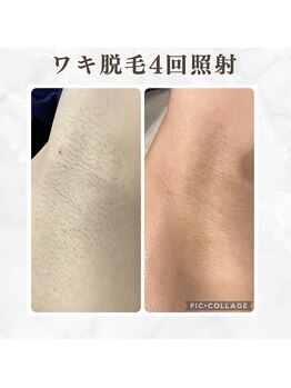 ボゴス(BOGOSS)/脇4回照射