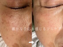 サロンドシエル カスガイ(Salon de Ciel kasugai)/確かな手応え感じられるシミケア