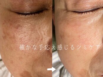 サロンドシエル カスガイ(Salon de Ciel kasugai)/確かな手応え感じられるシミケア