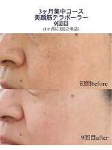 リアプア(Li'a)/気になる毛穴悩みも一緒に改善