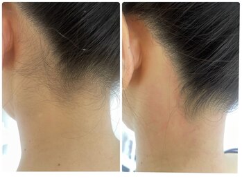 ウェイビーズ エステ(wavy's.esthetic)/【ビフォーアフター】うなじ脱毛